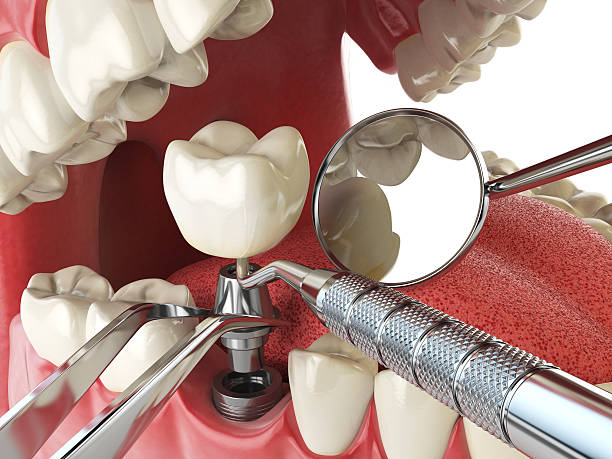 Best Knocked-Out Tooth Emergency  in Helena Valley Northeast, MT